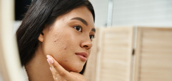 6 Adult Acne Causes & Best Ways to Treat It