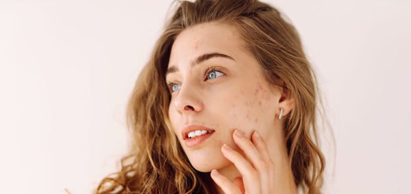 What Is the Best Serum for Acne-Prone Skin & Getting Rid of Dark Spots?