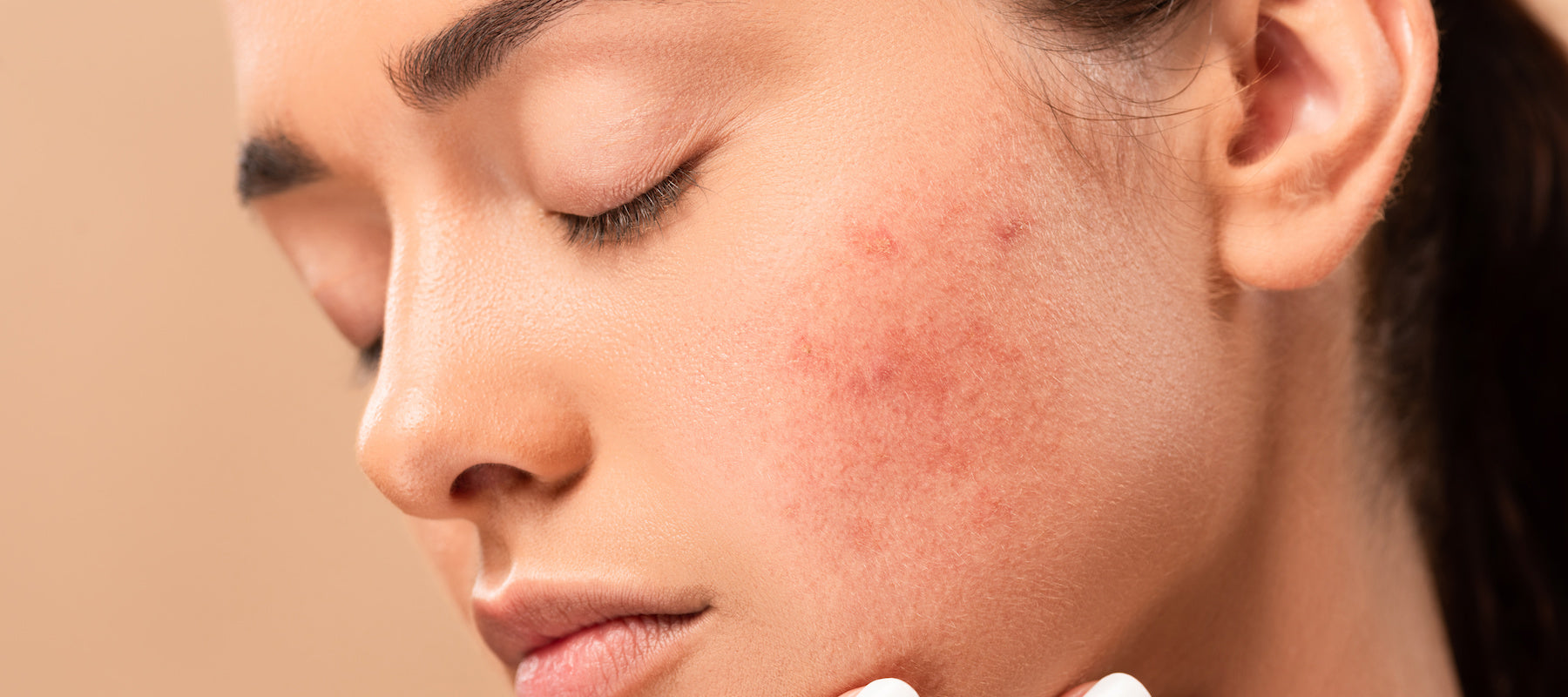Best Face Serum Routine for Acne Prone Skin