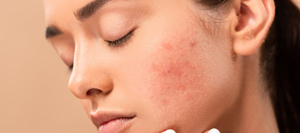 Best Face Serum Routine for Acne Prone Skin