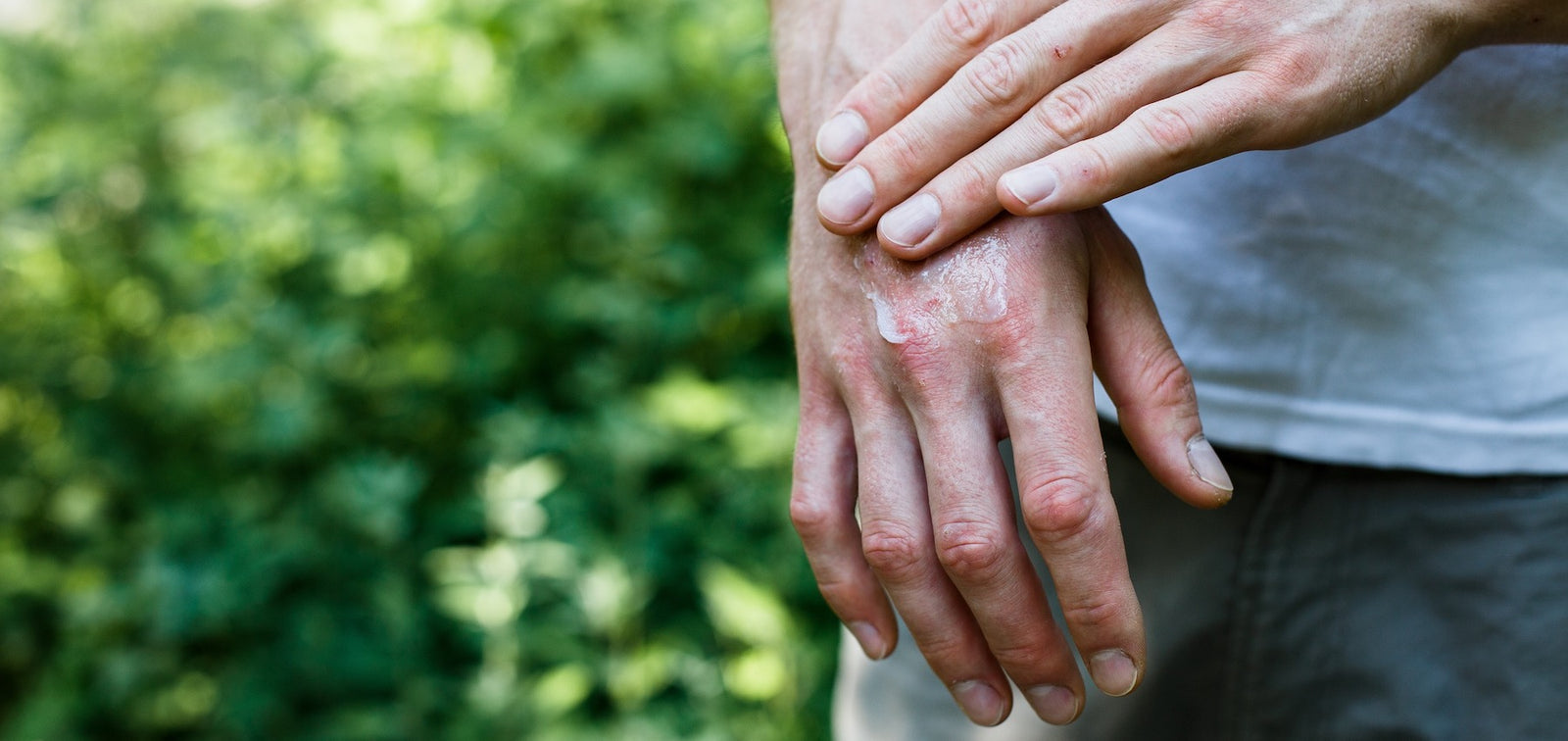 Eczema 101: What to Know & How to Treat It