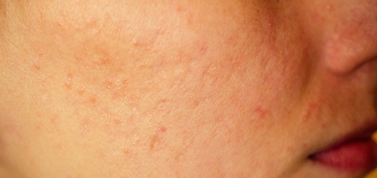 What is the Best Product to Reduce the Appearance of Acne Scars?