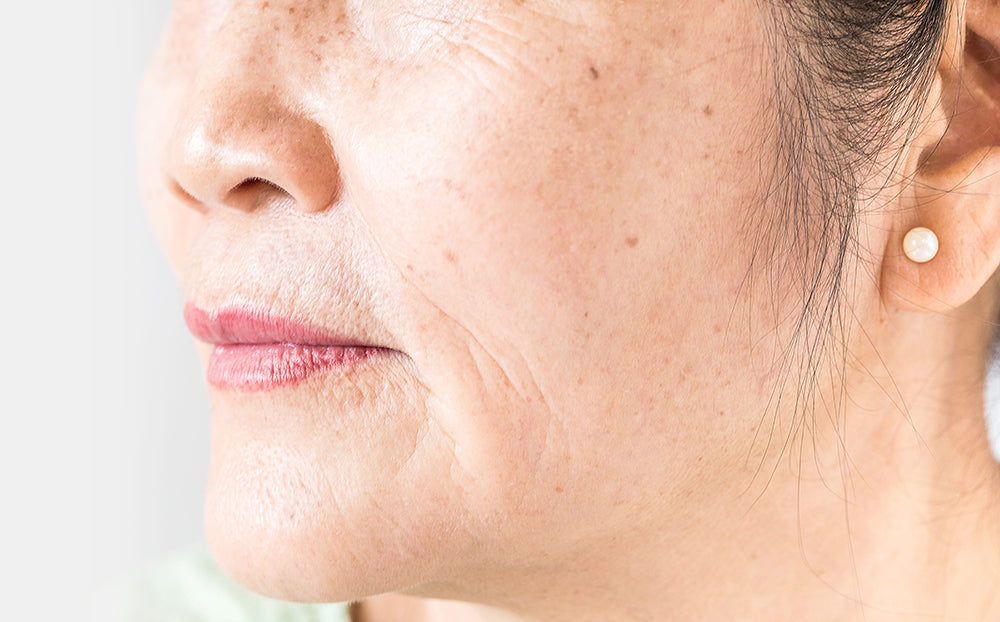 Can Hyaluronic Acid Cause Dryness? What You Should Know