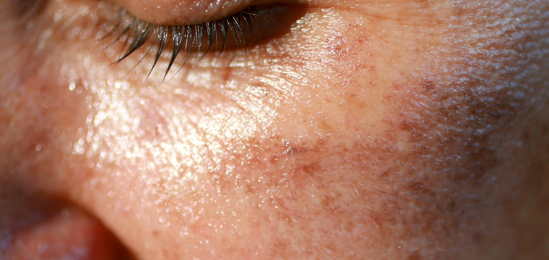 5 Tips for Treating Hyperpigmentation