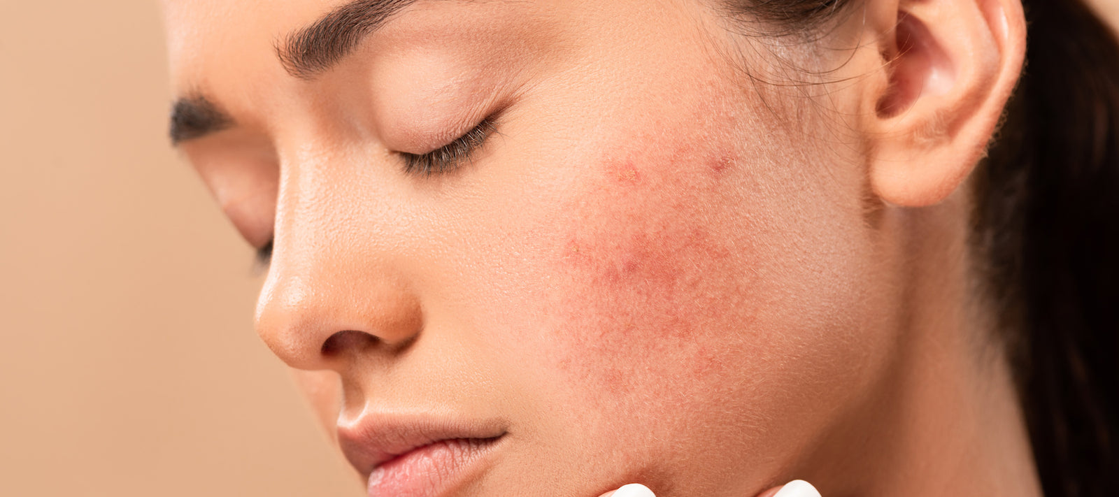 Best Face Serum Routine for Acne Prone Skin