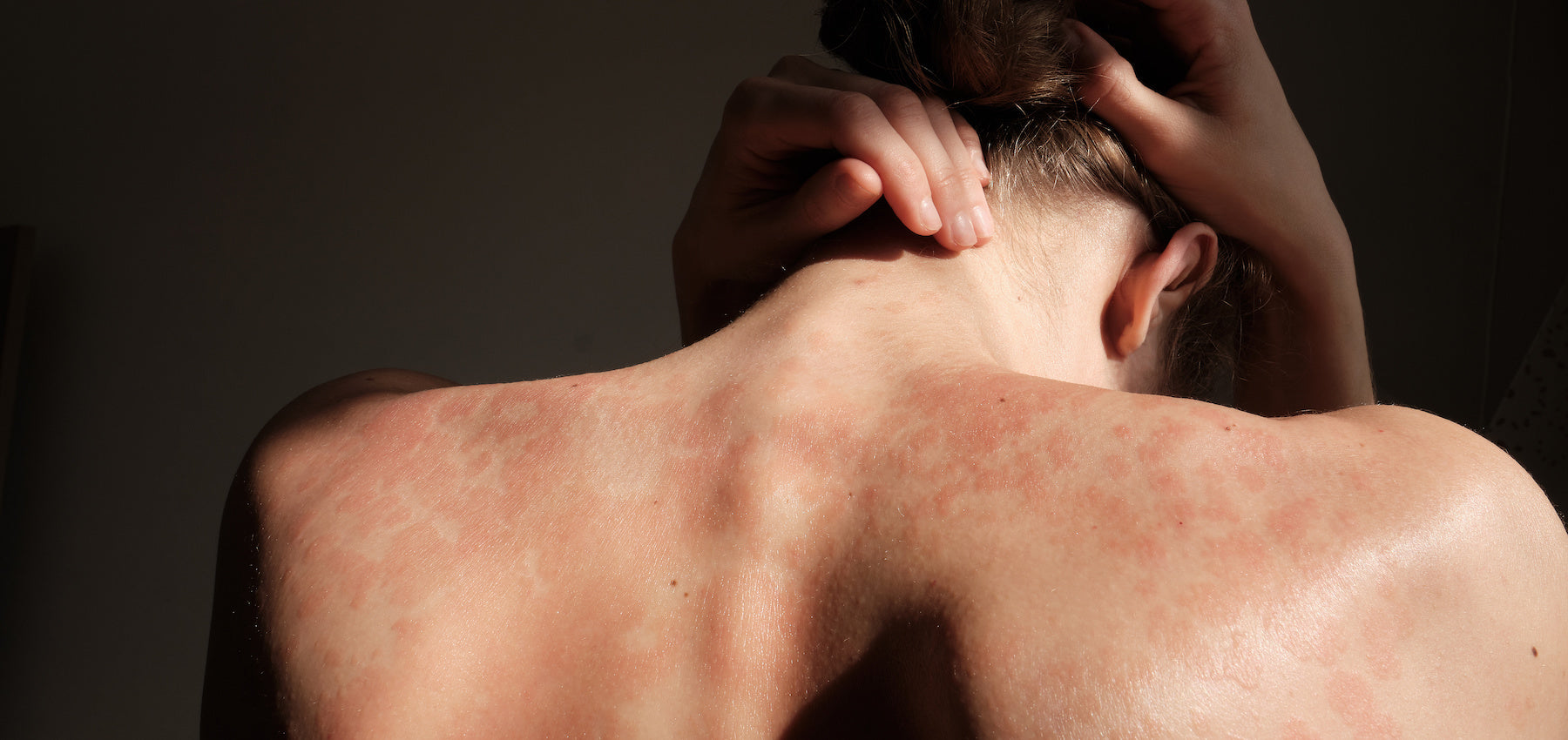 10 Home Remedies for Psoriasis: Natural Ingredients & Oils To Try
