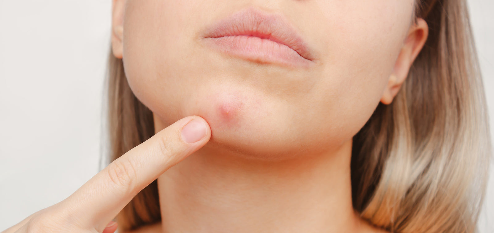 Hormonal vs. Bacterial Acne: How To Tell Which One You Have