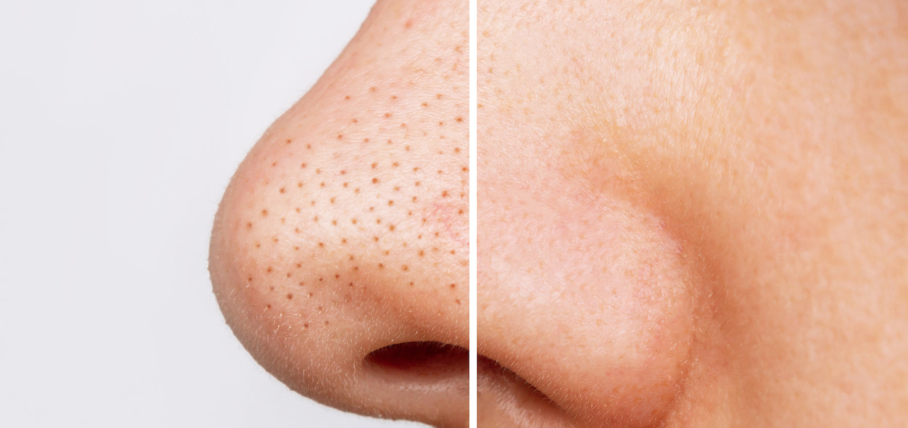 Can You Pop Blackheads? How to Treat & Prevent Them