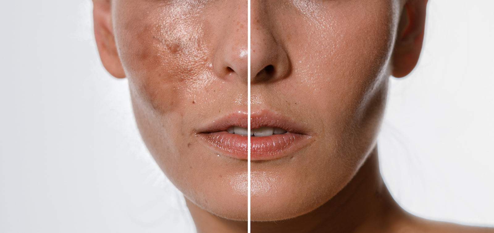 Best Products To Help Reduce Hyperpigmentation On Your Face