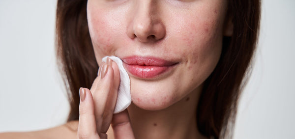 Chin Acne Guide: Why It Happens, How to Get Rid Of It & Prevent Breakouts